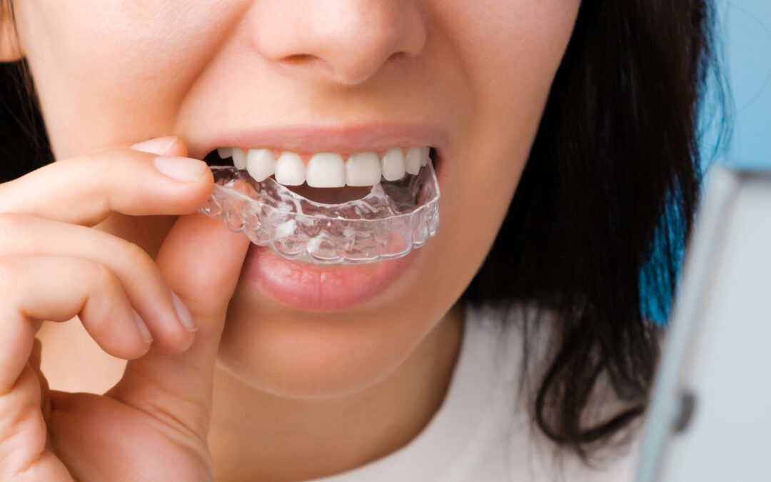 clear aligner