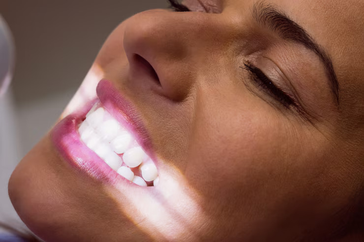 Bioclear Veneers